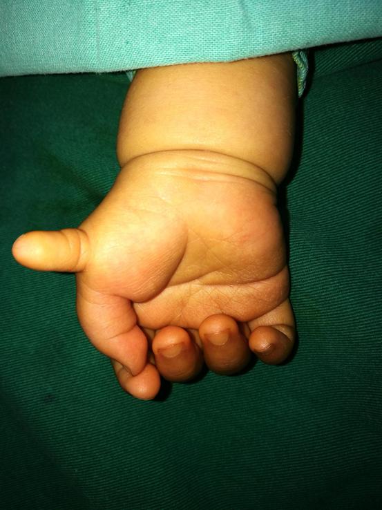 先天性并指畸形，什么时候手术最好？如果错过了怎么办？