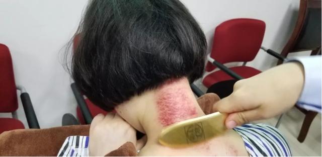 您是哪种感冒？对症治疗很重要