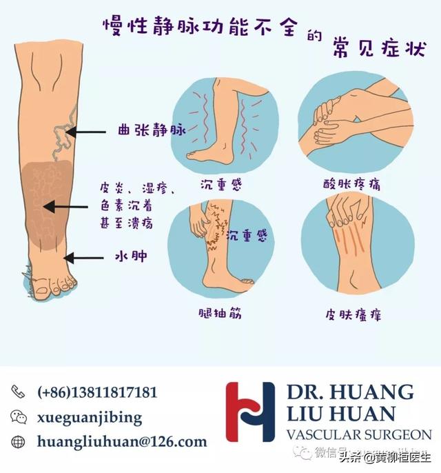 静脉曲张能跳舞吗,静脉曲张能跳舞吗跑步吗