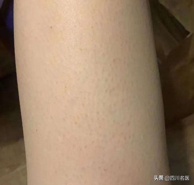 鸡皮肤很明显怎么办