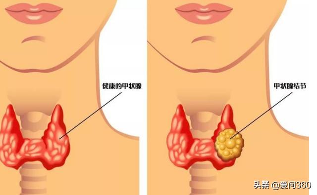 甲状腺的4个作用不可替代，不想甲状腺受损，这些事不能做