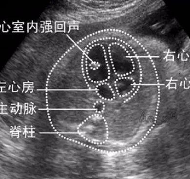 查出胎儿心室强光点好怕怕