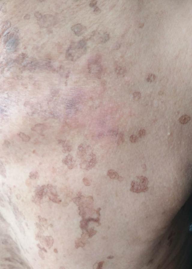 复合性汗孔角化化证