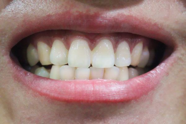 牙缝中间为什么会发黑（牙齿出现了怎样的问题）