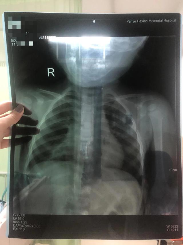 宝宝肺炎已经不发烧是否有必要住院