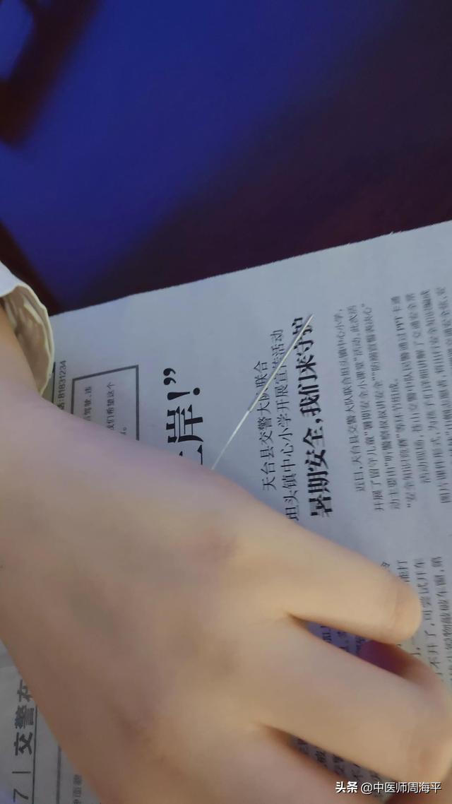 针灸医案分享3（同事的急性胃肠炎）