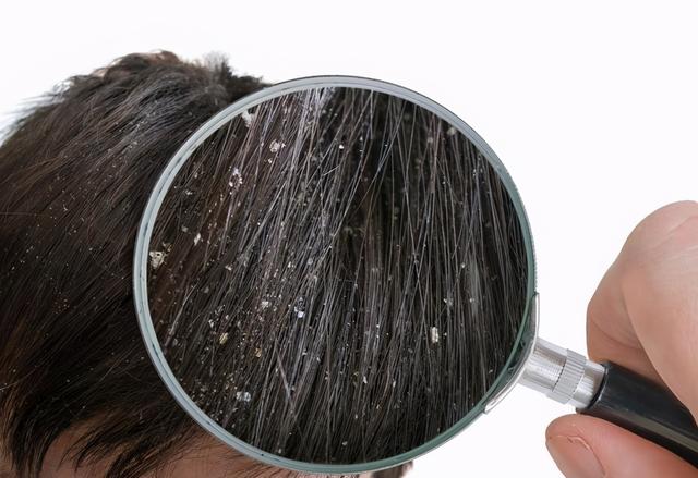 艾滋病三周皮肤角化严重