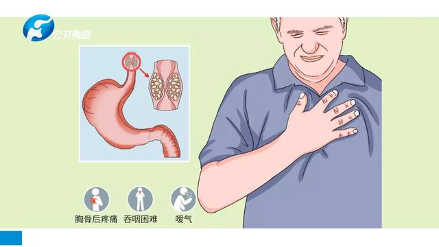 年轻并无金刚罩 消化道肿瘤莫忽视 | 河南省直第三人民医院消化病中心主治医师赵锦华