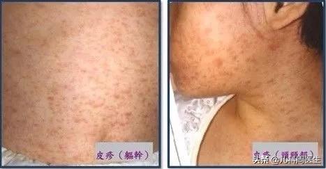 低烧怕冷两臂起鸡皮疙瘩