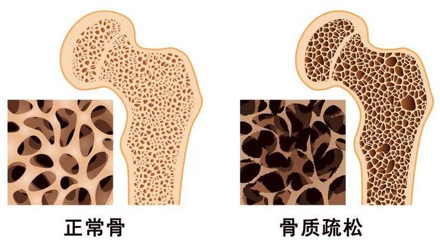 87岁骨科院士研究骨质疏松30余年 3类食物是“烂骨王”尽量少吃