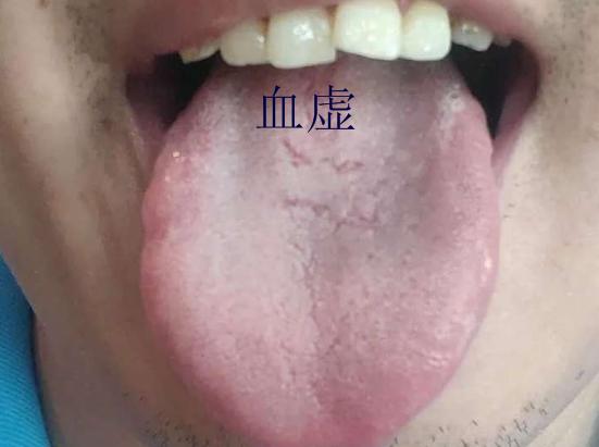 舌头有裂纹就是阴虚吗？教你形象地认识四种裂纹舌，十种舌象