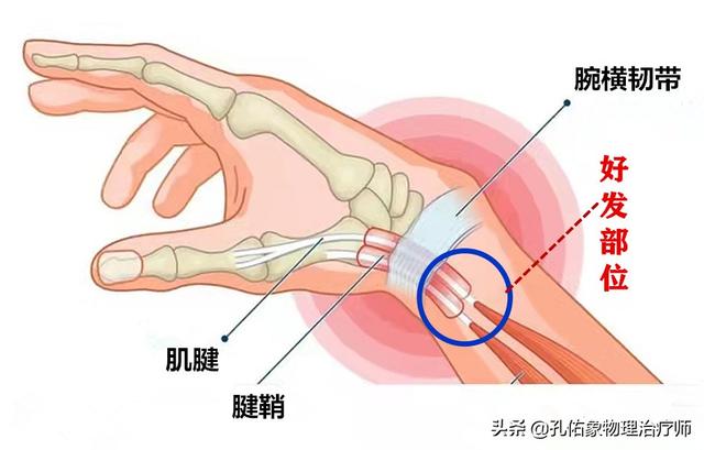 更年期女性极易遭受腱鞘炎的折磨 为什么 该如何治疗 全网搜