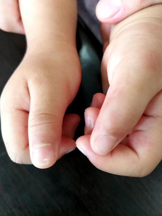 先天性并指畸形，什么时候手术最好？如果错过了怎么办？