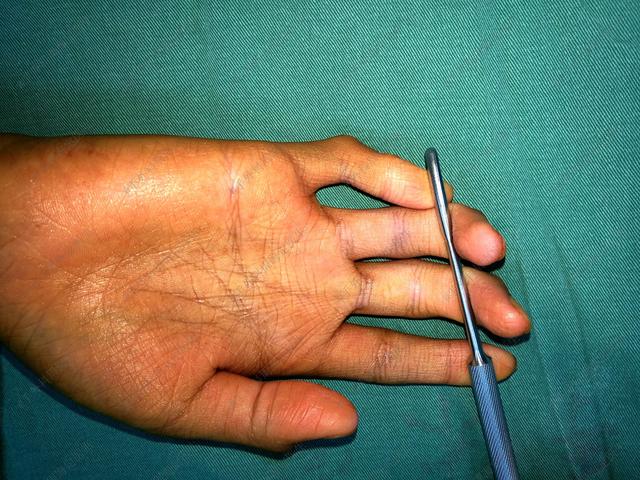 手外周海定宝宝并指术后出现手指倾斜，需要二次手术吗？