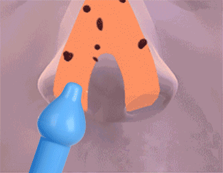 「未来医生冬季专题」帮宝宝擤鼻涕，用力过猛可能会造成听力损伤