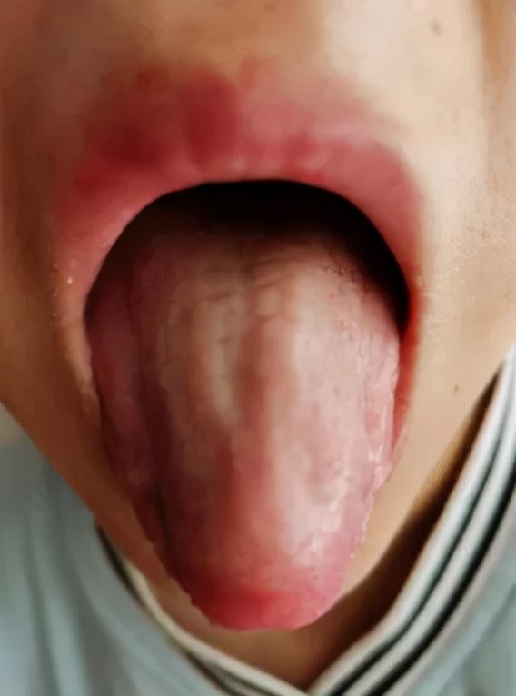 国医大师干祖望“宣肺法”治疗耳鸣耳聋，疗效甚佳