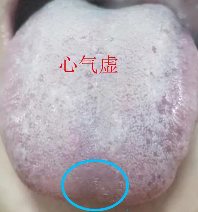 气虚了？是脾气虚、肺气虚还是肾气虚？各种气虚如何补？