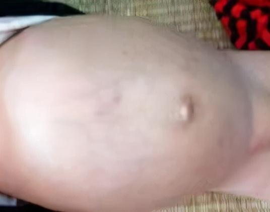 宝宝不吃饭日渐消瘦可能是疳积，欧阳医生教你辨别孩子是否有疳积