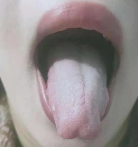 一补就上火？舌头有齿痕，舌苔比较厚？这7种舌象不要着急进补