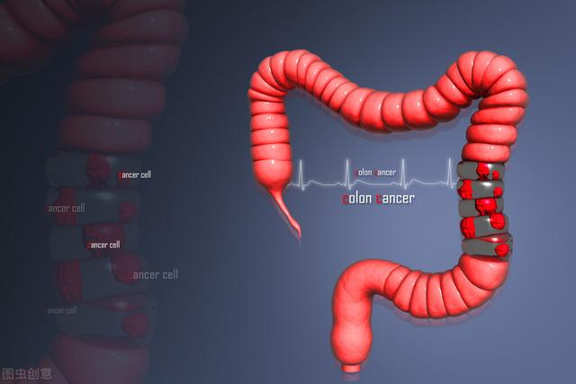 如何预防结肠癌？日常生活中如何护理自己的肠胃？