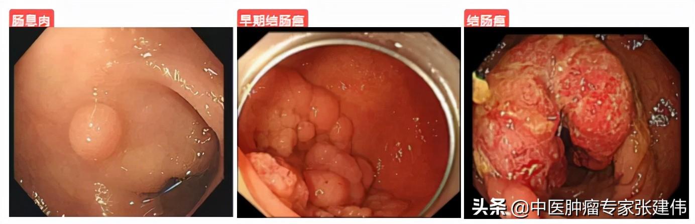 腸息肉一定要割了？醫生：越拖越危險，90%的大腸癌是它引起的