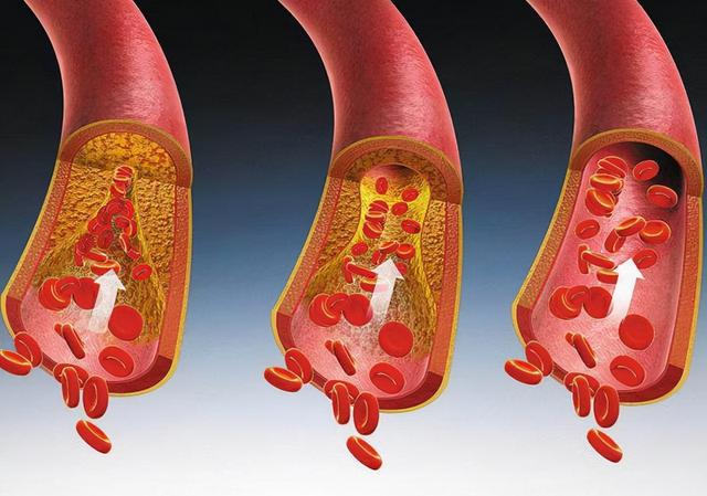 血脂高是面条影响的？医生建议：想平稳血脂，尽量少吃这2种食物