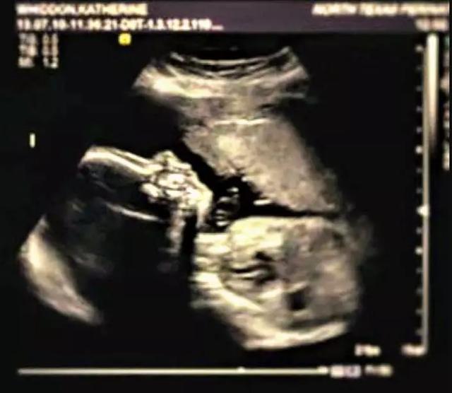 B超婴儿无四肢，18岁妈妈拒绝堕胎，冒险生子，把孩子养成男子汉