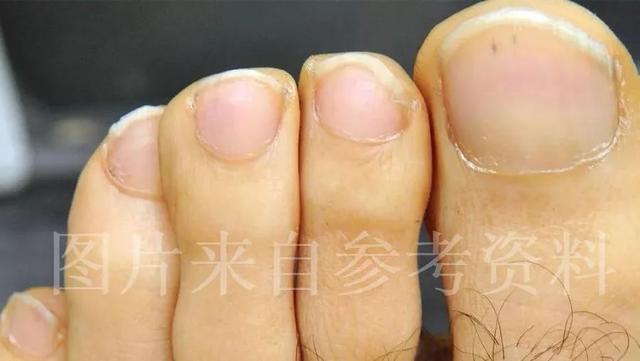 活人长尸斑活多久