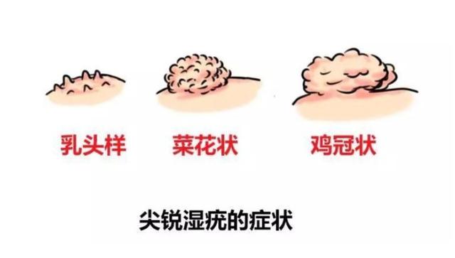角化症可以注射结核菌素疫苗