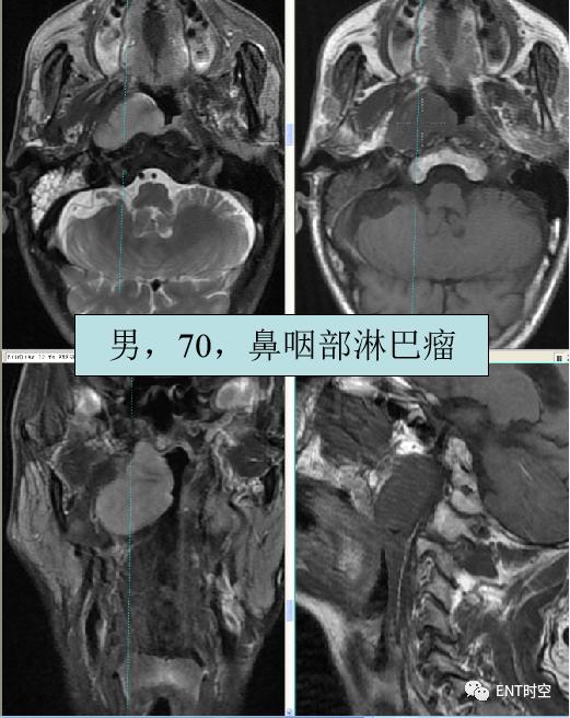 鼻咽鳞状上皮增生伴不全角化
