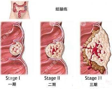 大便检查脓细胞三个加是什么意思