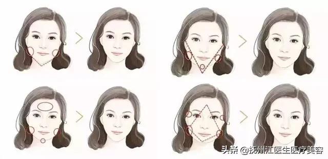 科普篇丨肉毒素 玻尿酸能够改善哪些脸型 玻尿酸品牌