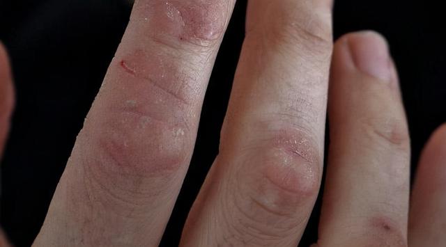 手脚皮肤布满“小水泡”，异常瘙痒，这一方面，可能出了问题