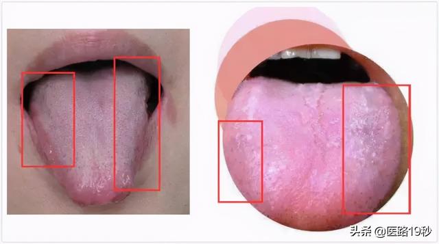 舌头上有瘀点是体内堵了吗？瘀血体质有什么特点，应该怎么调理？