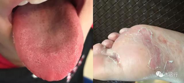 角化型手足癣用什么中药泡好