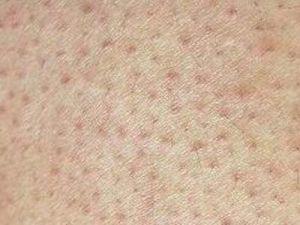 毛周角化症手臂背部