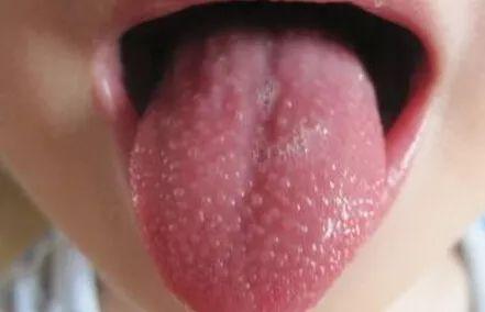 5岁儿童身上大片鸡皮疙瘩