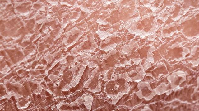 皮肤角化脱皮消银颗粒