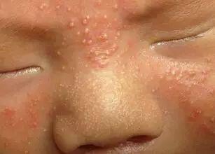 小孩脸部毛周角化图片