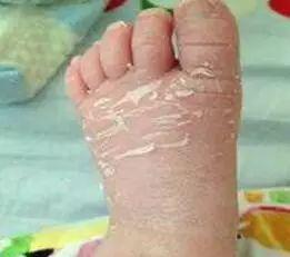 小孩脸部毛周角化图片