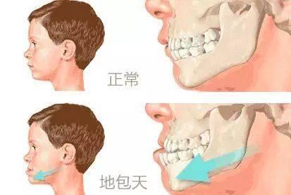 暴牙怎么办