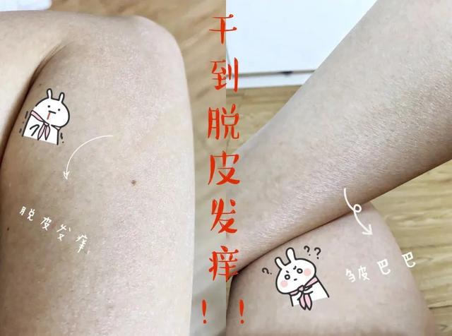 鸡皮疙瘩抓破后红肿