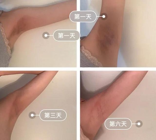 鸡皮疙瘩抓破后红肿