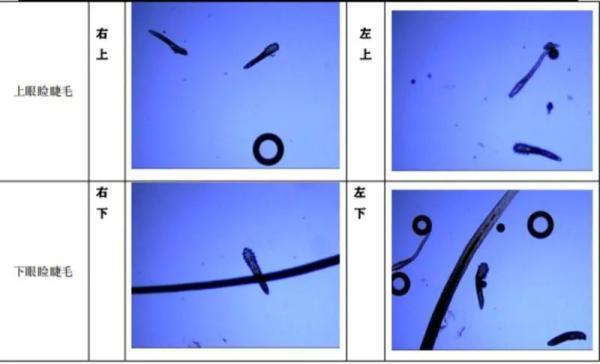 女子眼睛发痒掉睫毛 一查竟是被螨虫“筑窝”了「眼睫毛寄生虫怎么回事」