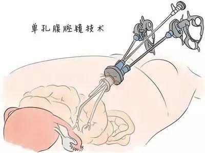 输卵管副伞切除术的症状及缓减治疗方法_健康症状网