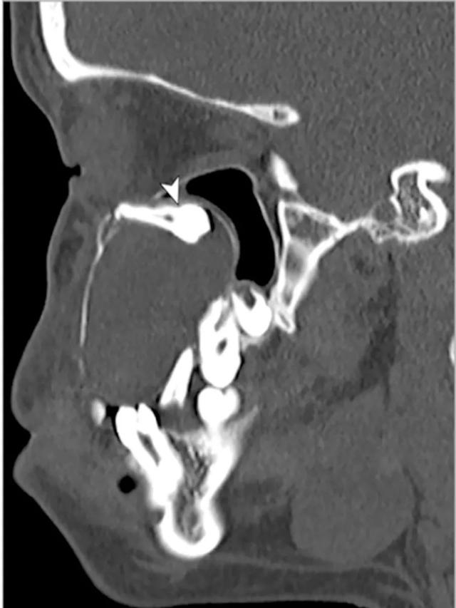 牙源性角化囊肿属于面裂囊肿