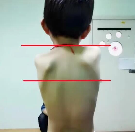 孩子驼背、高低肩，当心是脊柱侧弯