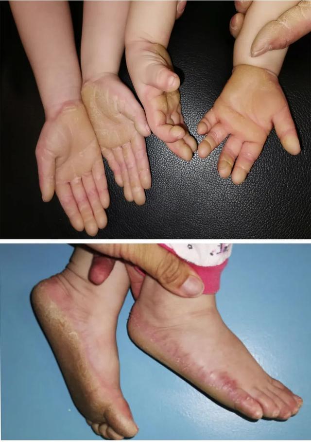 掌跖角化症生物药