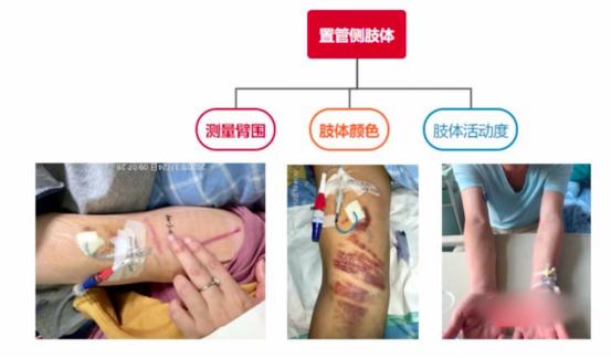 PICC置管你必須知道的那些事兒