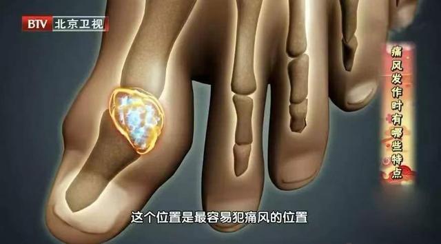 这类食材嘌呤高！一草一粥巧搭配，帮你排尿酸、缓痛风